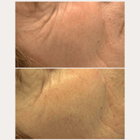 Anti-Age Day Cream – Vorher-Nachher-Vergleich der Stirn- und Schläfenhaut