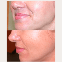 Lifting-Like Peptide Serum – Vorher-Nachher-Vergleich der Wange im Profil