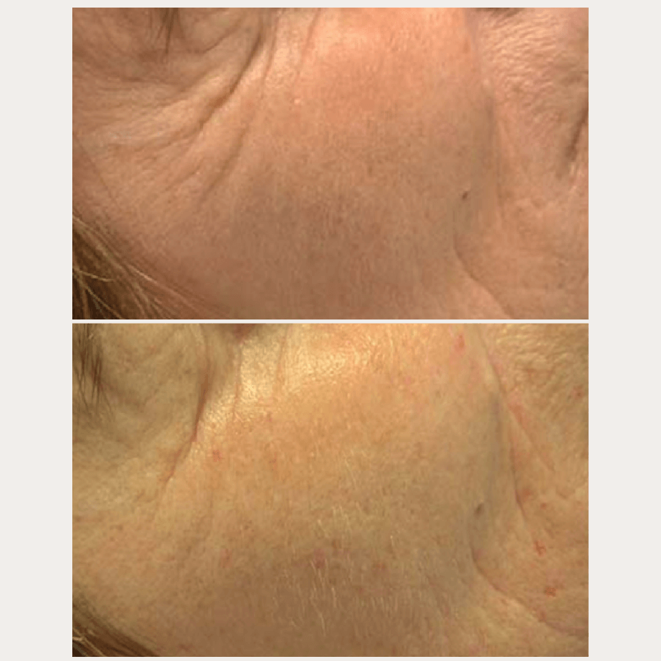 Lifting-Like Peptide Serum – Vorher-Nachher-Vergleich der Stirn- und Schläfenhaut