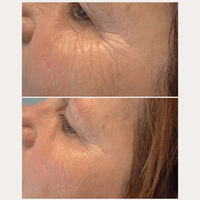 Lifting-Like Peptide Serum – Vorher-Nachher-Vergleich der Augenpartie
