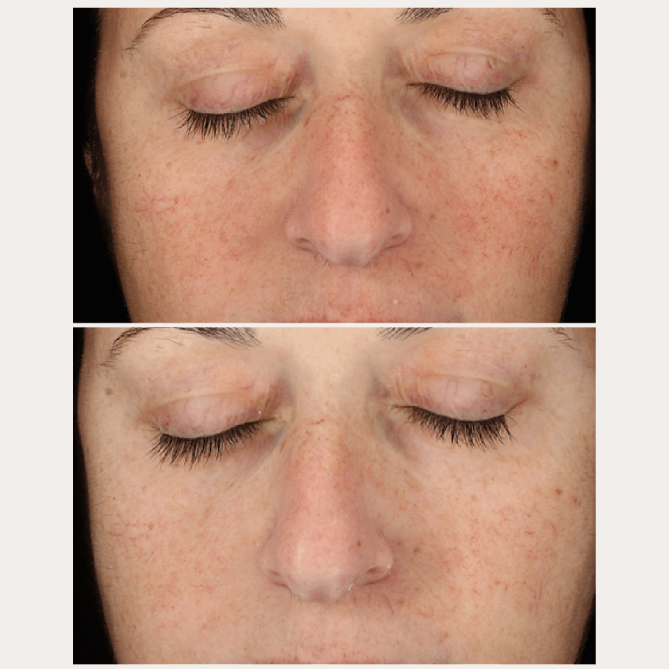 Anti-Pigment Spot Set