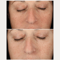 Thumbnail for Anti-Pigment Spot Set