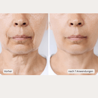 Thumbnail for Microneedling-Infusion Treatment <strong>für zuhause</strong> - Lifting Power Set