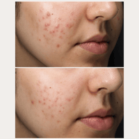 Thumbnail for Acne Set