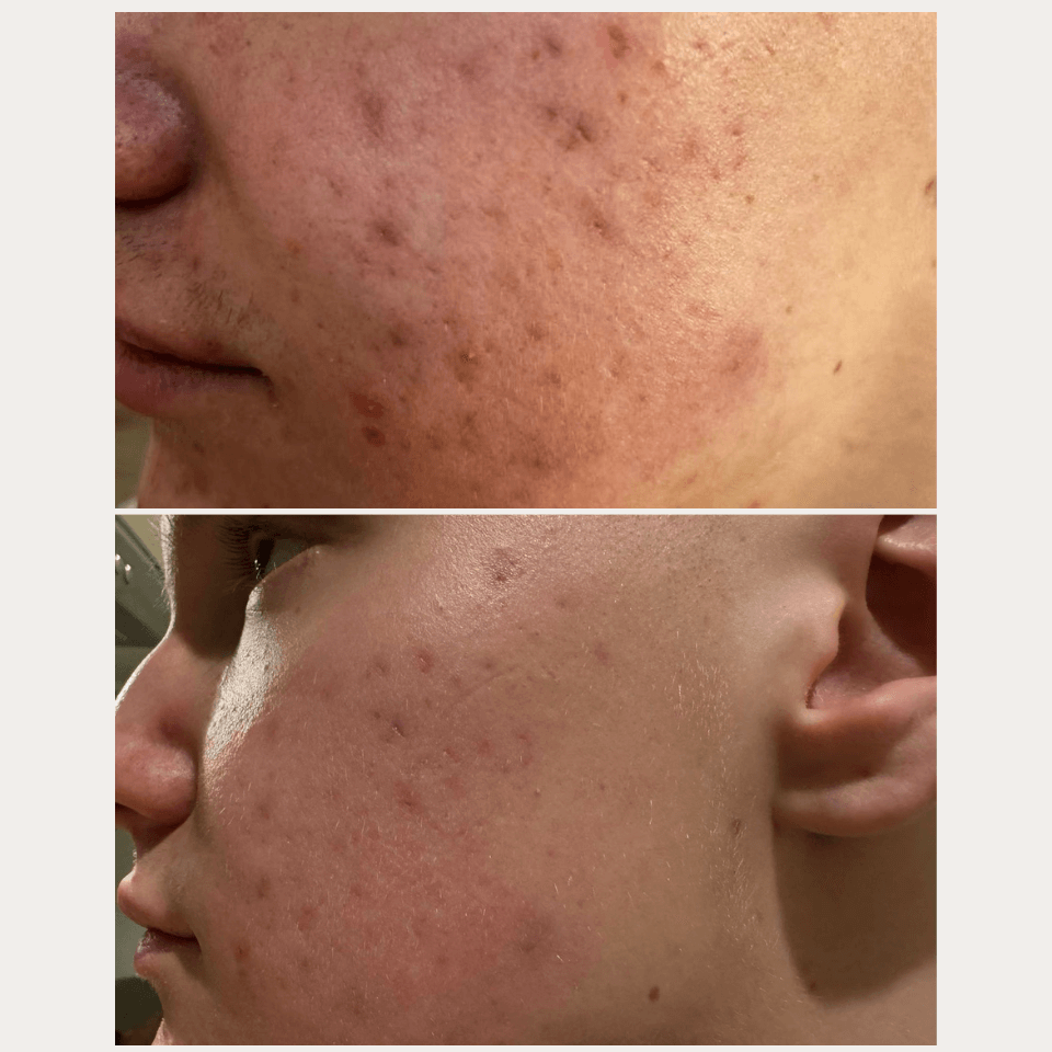 Acne Set
