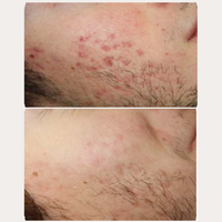 Thumbnail for Mature Skin Acne Set