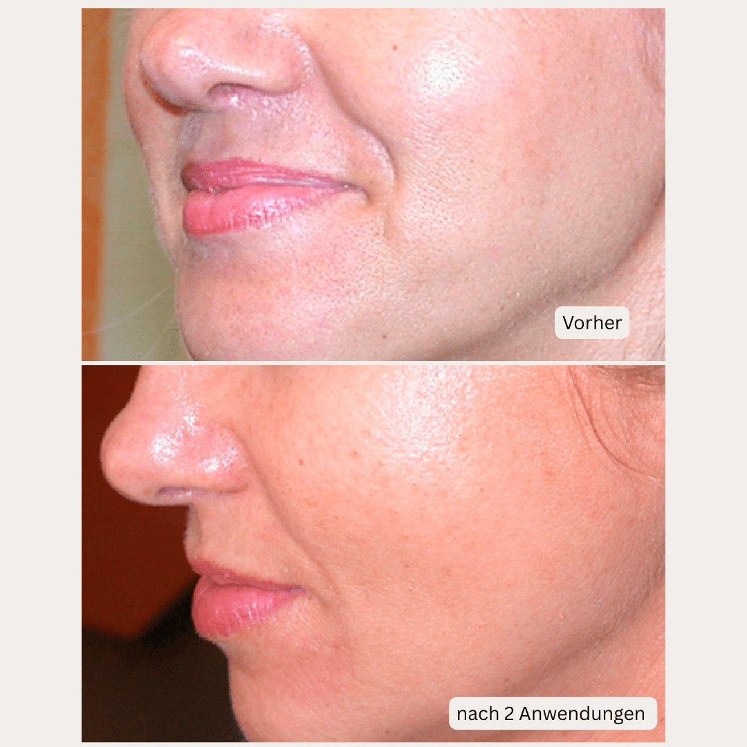 Microneedling-Infusion Treatment <strong>für zuhause</strong> - Lifting Power Set