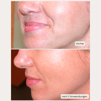 Thumbnail for Microneedling-Infusion Treatment <strong>für zuhause</strong> - Lifting Power Set