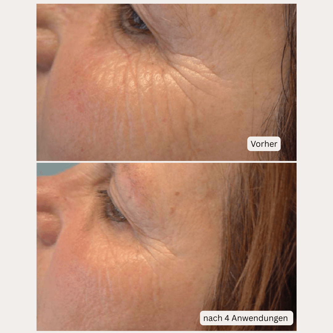 Microneedling-Infusion Treatment <strong>für zuhause</strong> - Lifting Power Set