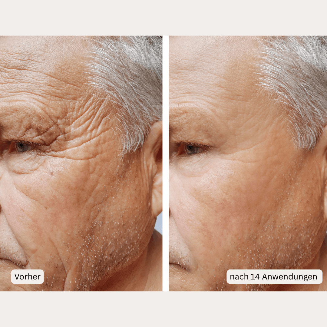 Microneedling-Infusion Treatment <strong>für zuhause</strong> - Lifting Power Set