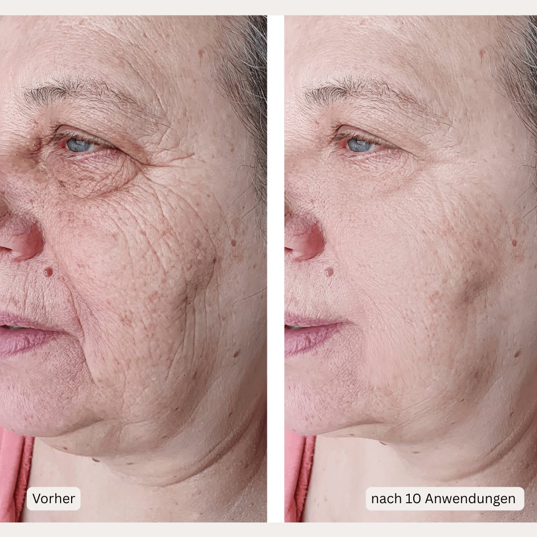 Microneedling-Infusion Treatment <strong>für zuhause</strong> - Lifting Power Set