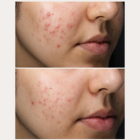 Thumbnail for Acne Set