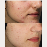 Thumbnail for Acne Set