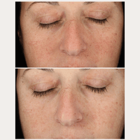 Thumbnail for Anti-Pigment Spot Set