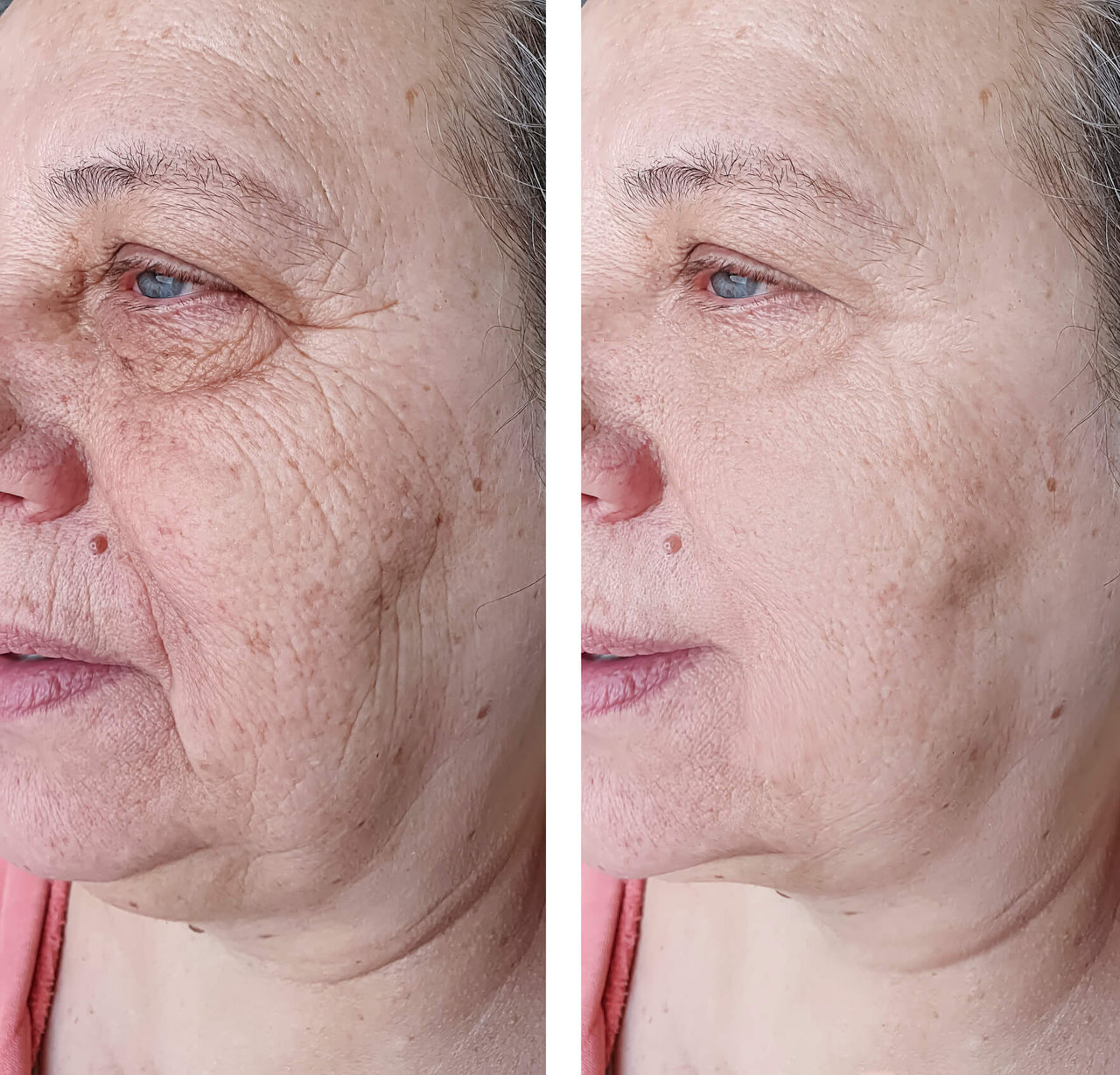 Lifting Power Set – Professionelles Micro-Infusion Treatment für Zuhause