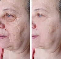 Thumbnail for Lifting Power Set – Professionelles Micro-Infusion Treatment für Zuhause